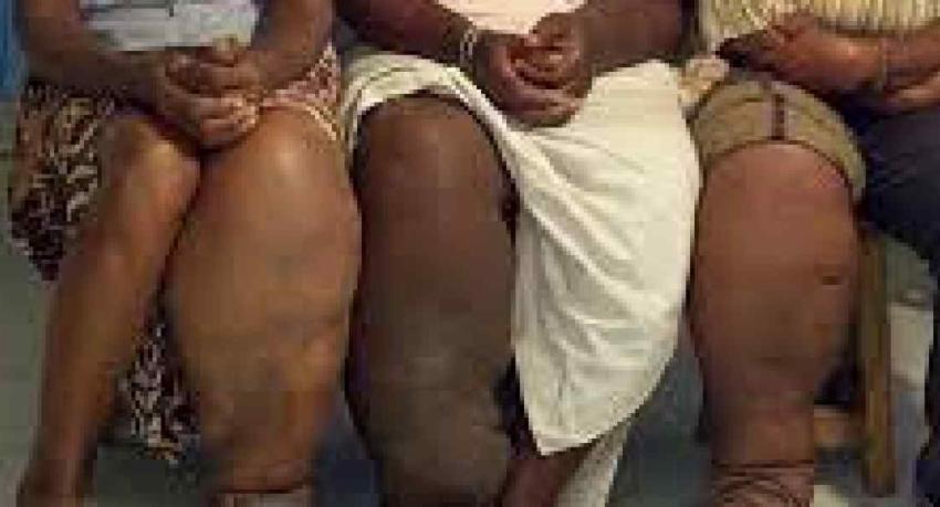 ජලාශ ආශ්‍රිත ප්‍රදේශවල බරවා රෝගීන් වාර්තාවීම ඉහළට.